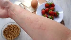 Food Allergy Treatment in Alaknanda